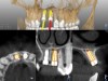 Fig 11. Pre- and post-placement CBCT scan matched with DICOM data and accuracy evaluation for site No. 8. Yellow outlines of implant represent the planned implant position, while red outlines show the actual implant position outcome.