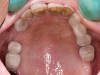 Fig 6. Maxillary dentition showing deteriorating restorations and decay.