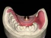 Fig 12. Mandibular base plate holding the pin in a rotatable nut, which allows the dentist to parallel with the maxillary striking plate.