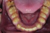 Figure 7. Preoperative mandibular occlusal view.