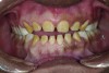 Figure 15. Final anterior tooth preparations.