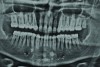 Figure 26. Postoperative OPG; note the vitality of the anterior teeth.