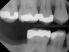 Fig 1. In 2009 patient No. 1 presented with a missing tooth at site No. 31.