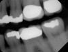 Fig 3. Patient No. 1, contralateral side; in 2009 patient presented with teeth Nos. 15 and 18. Subsequently, tooth No. 18 was extracted due to tooth fracture.