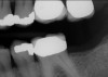 Fig 4. Patient No. 1 in 2016, with extrusion of tooth No. 15. Two different experiences in the same mouth, as shown in Figs 1–2 and Figs 3–4, underscore the unpredictability of extrusion.