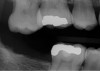 Fig 6. Patient No. 3 presented for an implant restoration at site No. 31 to eliminate pain due to chewing on the ridge from extruded tooth No. 2. Tooth No. 2 was equilibrated to eliminate the patient’s symptoms. In some patients, super-eruption can be severe enough to preclude an implant restoration due to a lack of restorative space.