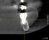 Fig 2. The implant restoration was completed 10 years ago and the patient has been able to accommodate the altered nerve sensation. Recently, the patient presented at one of the authors’ offices and a CBCT scan was ordered. It demonstrated that the implant at site No. 30 is closer to the inferior alveolar canal than previously envisioned and may be causing compression on the nerve.
