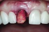 Fig 4. The root was atraumatically extracted using periotomes.