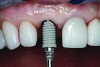 Fig 6. Implant insertion.