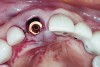 Fig 7. Occlusal view of the implant after insertion.