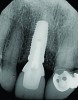 Fig 18. Radiograph taken immediately after placement of the definitive crown confirmed complete removal of all the cement.