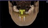 CBCT scan with virtually planned implants with reference bodies (containing fiducial markers) to aid in fabrication of chairside CAD/CAM implant surgical guide.