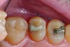 Fig 1. Excellent clinical condition of a 26-year-old Class II silver cermet restoration in a second permanent premolar tooth.