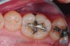 Fig 2 and Fig 3. In Case 1, occlusal (Fig 2) and buccal (Fig 3) preoperative views of defective Class I and Class V amalgam restorations on mandibular first permanent molar.