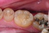 Fig 4 and Fig 5. Occlusal (Fig 4) and buccal (Fig 5) 42-month recall views of the Class I and Class V GIC restorations placed with bulk-fill EQUIA technique.