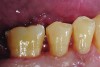 Fig 11. Completed bulk-filled GIC restorations showing excellent esthetics and surface smoothness.