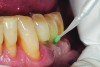 Fig 7. Cavities were cleaned with 20% polyacrylic acid solution.