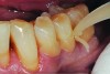 Fig 8. Cavities were bulk-filled with high-viscosity auto-curing GIC.