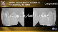 Treatment Solutions Simplified with a New and Innovative Internal Hex Implant Webinar Thumbnail