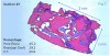 Fig 7. Low-power hematoxylin and eosin stain of trephine bone core sample from Case 1 showing conglomeration of vital bone, residual bone allograft, and connective tissue.