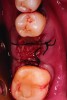 Fig 11. Intentional non-primary closure following the placement of an amnion-chorion barrier over the bone allograft.