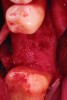 Fig 12. Note the significant formation of bone and repair of the buccal osseous defect at 3 months healing.