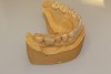 Fig 5. Radiographic guide with radiopaque tooth.