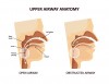 Fig 3. Open and obstructed airway, sitting position.