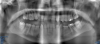 Fig 5. Panoramic radiograph, 18-year-old brother.