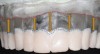 Fig 1. Space between the cervical portion of the teeth and the crestal soft tissues is indicative of a composite defect.