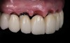 Fig 3. Natural emergence profile of the implant crowns and the pontic in a tooth-only defect prosthesis.