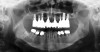 Fig 5. Axial implant placement, with presence of bone in zones 1, 2, and 3.