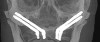 Fig 9. Quad-zygoma concept, with lack of all three zones of maxilla.