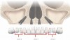 Fig 6. Tilted posterior and traditional anterior implants, with presence of bone in zones 1 and 2 only.