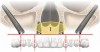 Fig 7. The zygoma concept; presence of bone in zone 1 only.