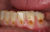 Fig 3. Facial erosion of maxillary (Fig 2) and mandibular (Fig 3) anterior teeth.