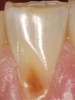 Fig 10. BEWE scoring system: score 0 = no erosive tooth wear (Fig 8); score 1 = initial loss of surface texture (Fig 9); score 2 = distinct defect, hard-tissue loss <50% of surface area (Fig 10); score 3 = hard-tissue loss ≥50% of surface area (Fig 11)