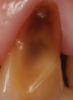 Fig 11. BEWE scoring system: score 0 = no erosive tooth wear (Fig 8); score 1 = initial loss of surface texture (Fig 9); score 2 = distinct defect, hard-tissue loss <50% of surface area (Fig 10); score 3 = hard-tissue loss ≥50% of surface area (Fig 11)