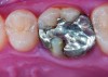 Fig 9. Preoperative view (Fig 9), preparation with composite block-out restoration (Fig 10), and final cementation of CL-IIb material (Fig 11) (final ceramic contour and stain by Steve Lee, CDT, MDC).