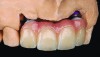 Fig 13. Porcelain-layered zirconia framework (CL-IIIb) with layered pink porcelain for the gingiva (Fig 13); final image in the mouth of the porcelain-layered zirconia framework (Fig 14) (images courtesy of Aram Torosian, MDC).