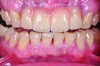 Fig 14. Porcelain-layered zirconia framework (CL-IIIb) with layered pink porcelain for the gingiva (Fig 13); final image in the mouth of the porcelain-layered zirconia framework (Fig 14) (images courtesy of Aram Torosian, MDC).