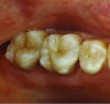 Fig 17. Two-molar full-crown porcelain-fused-to-metal restoration made with a CL-IV substrate.