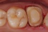 Figure 10  Final tooth preparation to accept a PFM crown.