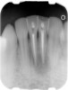 Figure 12  Endodontically treated mandibular central incisors that require only restoration of endodontic access holes with composite.
