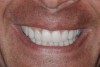 Fig 2. Resolution of gummy smile after treatment in patient shown in Fig 1.