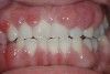 Fig 3. Patient with a gummy smile due to gingival hyperplasia (courtesy of William Becker, DDS, MSD, Tucson, AZ).