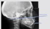 Fig 4. Lateral radiograph of patient with VME (anterior maxillary height: palatal plane-incisal edge = 29 mm to 31 mm).