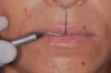 Fig 5. External lip dimension.