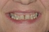 Fig 7. Anterior gummy smile.