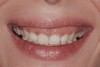 Fig 8. Anterior–posterior gummy smile.